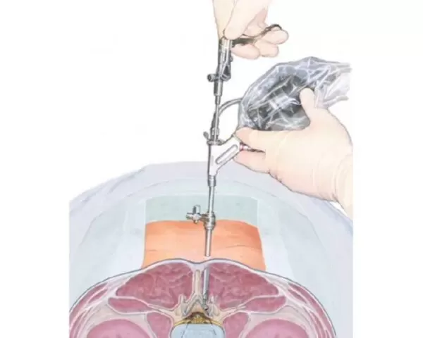 endo-blog