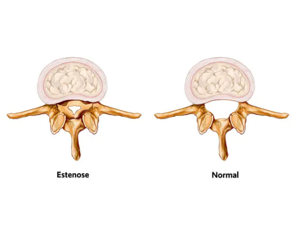 estenose05