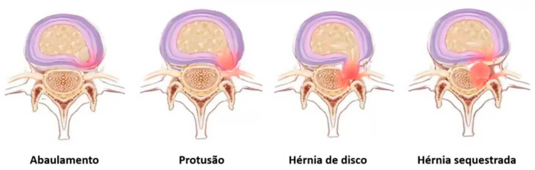 Outras Doenças do Disco